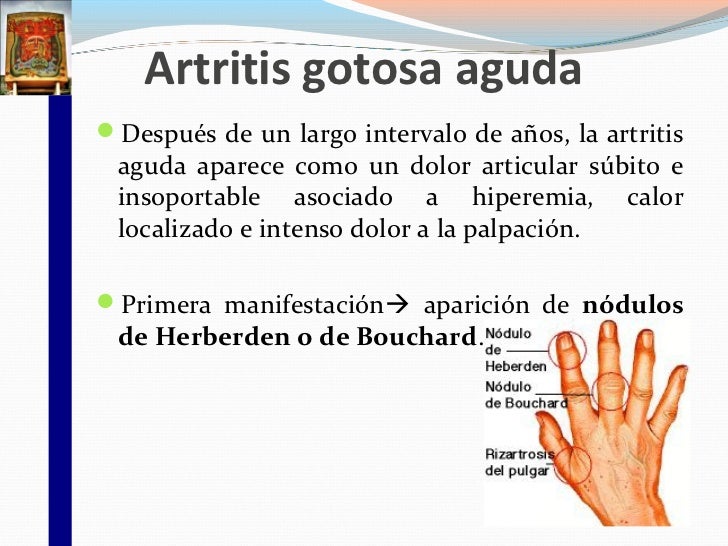 artritis gotosa aguda